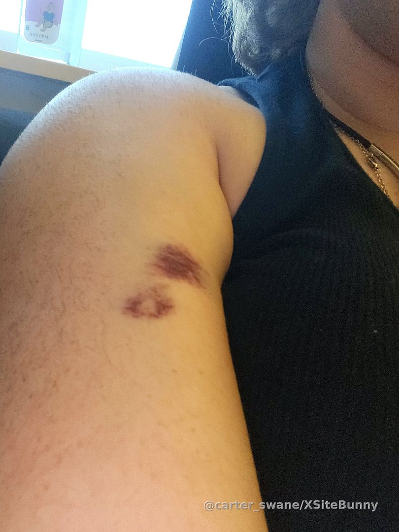 Went to the ER and got this gnarly bruise from the IV 